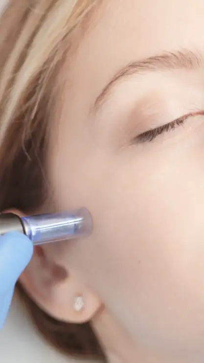 Rostro de mujer relajada realizandose un tratamiento facial Dermapen