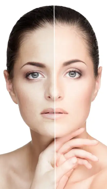 Foto de mujer mostrando un lado de la cara sin tratamiento y el otro con tratamiento