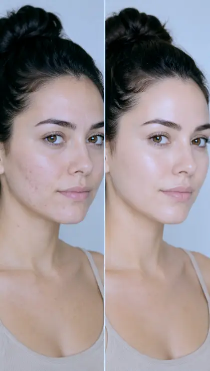 Paciente recibiendo peeling químico médico en Freya